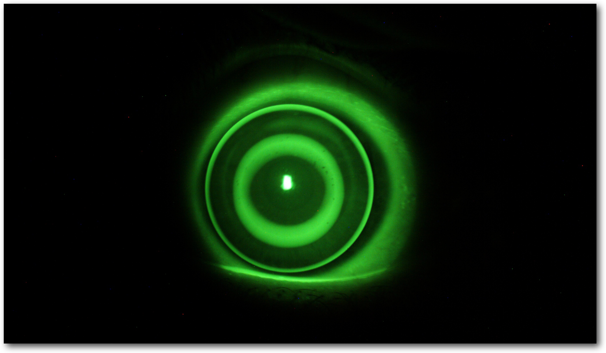 Immagine fluoresceinica di una lente orto-k applicata, osservata alla lampada a fessura